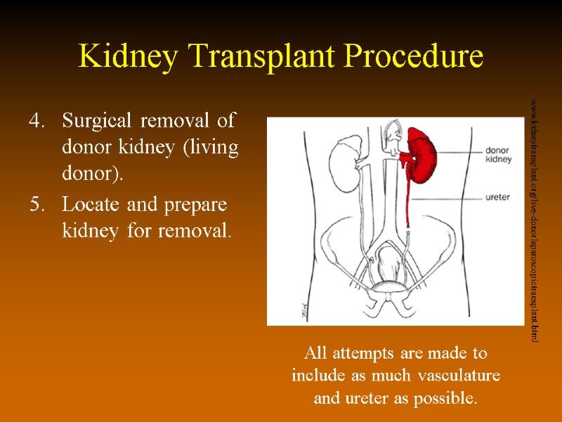 Kidney Transplant Procedure Surgical removal of donor kidney (living donor). Locate and prepare kidney